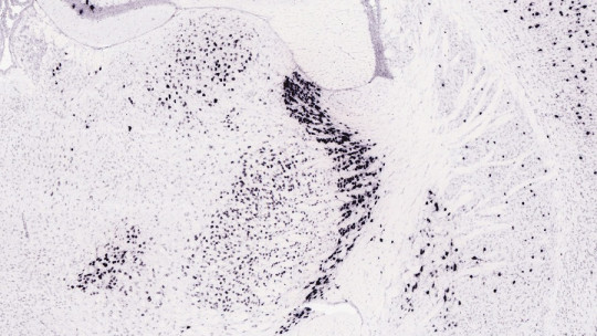 Thalamic syndrome