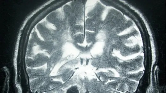 The 4 Types of Stroke (symptoms and Causes) The 4 Types of Stroke (symptoms and Causes)