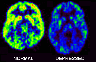 depression-neuroimage.gif