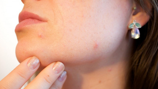 The 8 Types of Acne and Their Characteristics