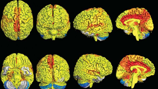 The Female Brain is More Active Than the Male, According