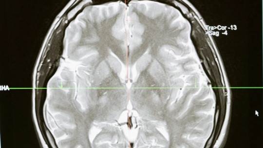 Neurological bases of reading