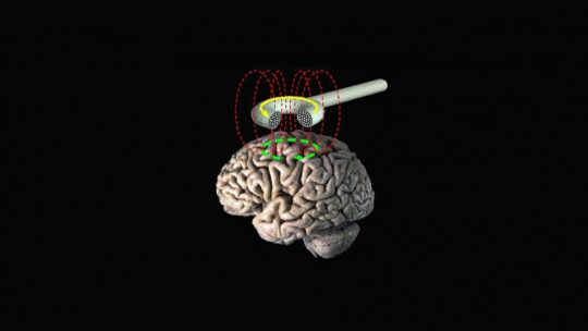 Transcranial magnetic stimulation