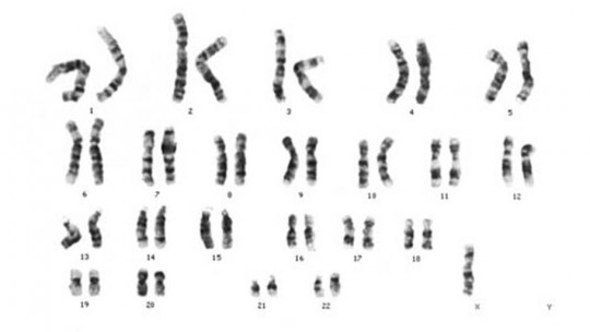 Turner Syndrome: Symptoms, Types, Causes and Treatment