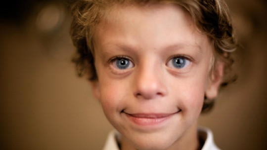 Child with Williams syndrome.