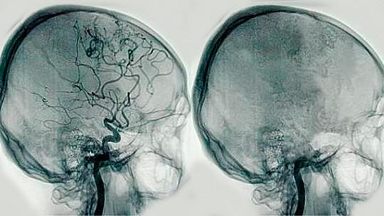 Cerebral Angiography: What is it and What Disorders Can it