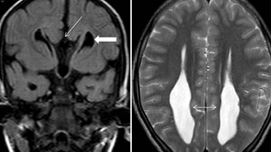 Discover COLPOCEPHALY: Causes, Symptoms & Treatment - Expert Insights