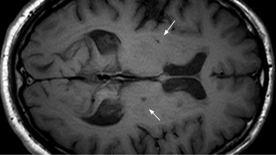 Brain scan showing traces of a brain infarction.