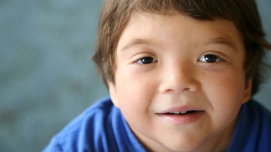 Noonan Syndrome: Causes, Symptoms and Treatment