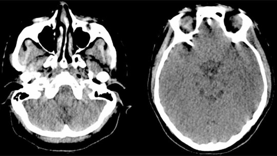 Pfeiffer Syndrome: Causes, Symptoms and Treatments