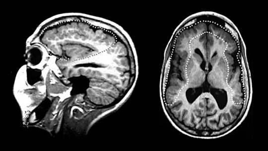 Polymicrogyria: Causes, Symptoms and Effects