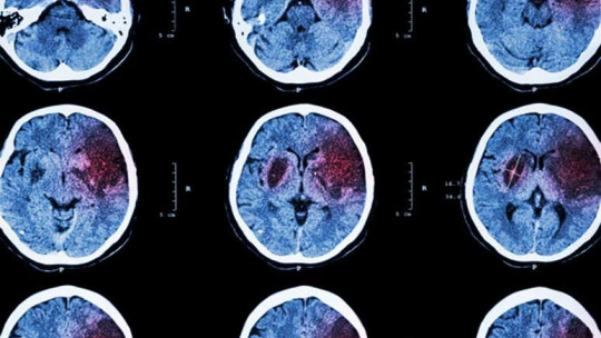 Stroke: Definition, Causes, Symptoms and Treatment