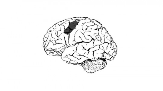 Transcortical Aphasia (sensory, Motor and Mixed)