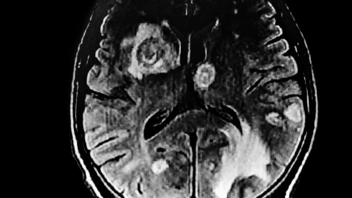 brain-toxoplasmosis