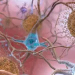 They Discover the Origin of 30% of Alzheimer's Amyloid Plaques